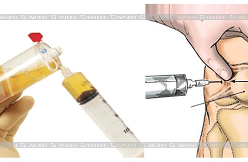 Tiêm Chất Nhờn Khớp Gối – Giải Pháp An Toàn Thay Thế Phẫu Thuật